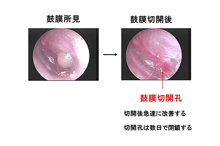 鼓膜所見と鼓膜切開後
