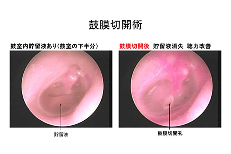 鼓膜切開術前後の比較画像