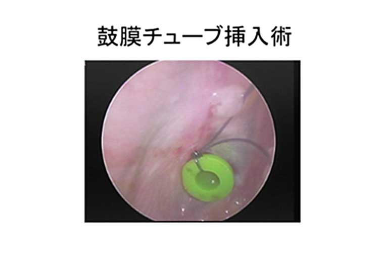 鼓膜チューブ挿入術