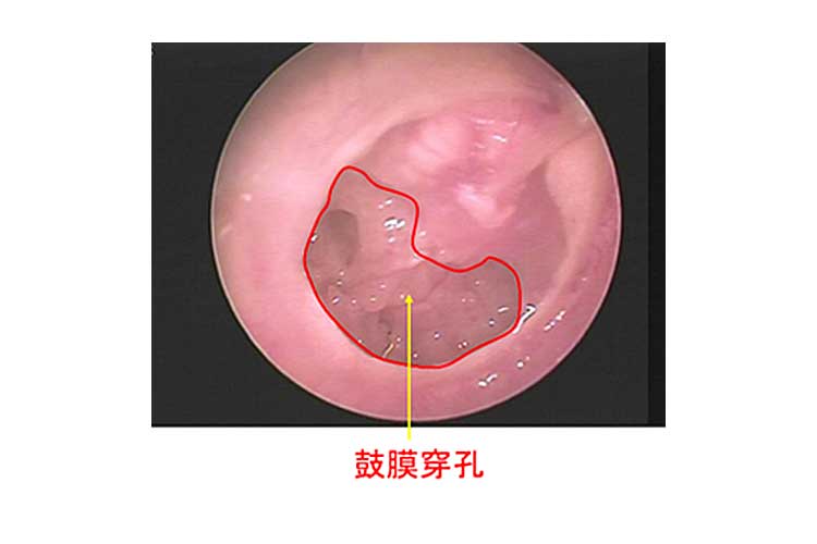 鼓膜穿孔