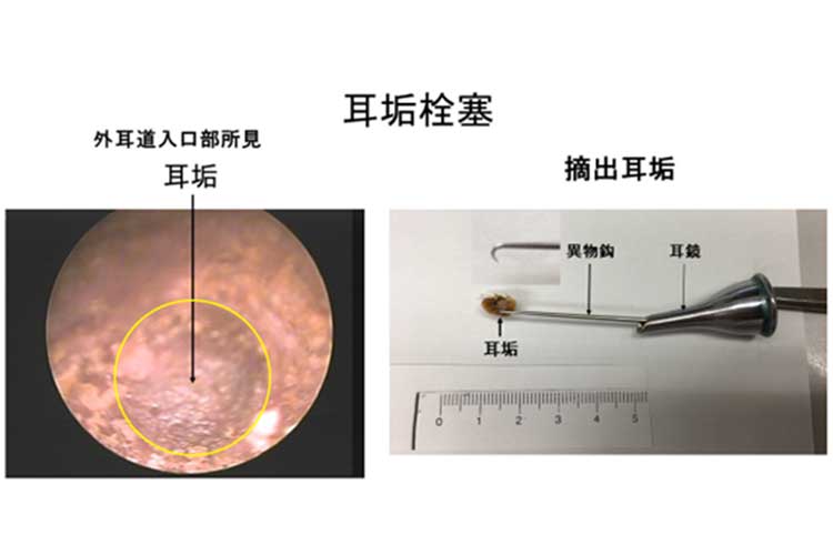 耳垢栓塞